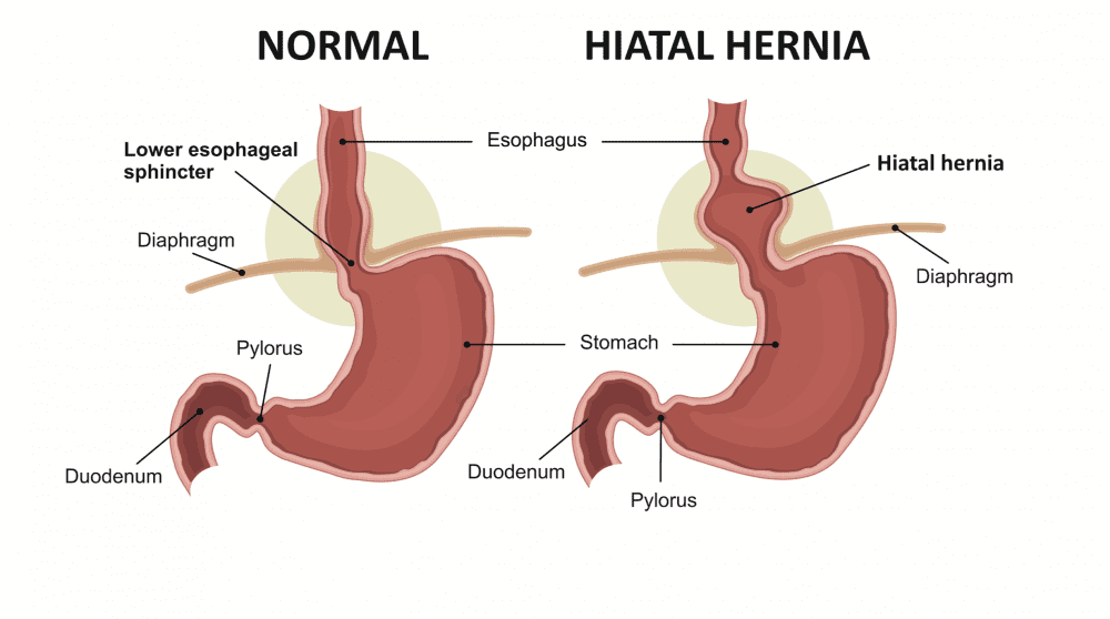 Hiatal Hernia and Treatment