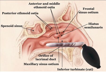 The Bilateral Nasal Specific procedure at Dunn Chiropractic Clinic